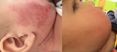 Infantile Eczema 1 Case