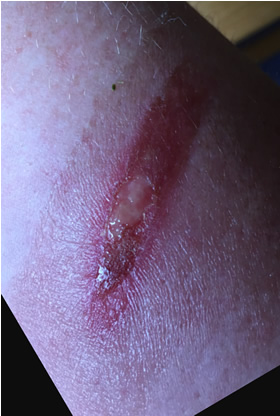 2nd degree burn forearm Day 1