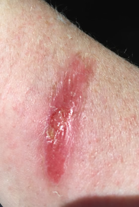 2nd degree burn forearm Day 2