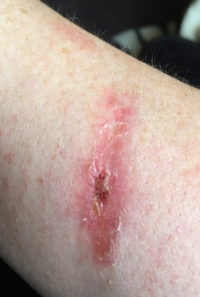 2nd degree burn forearm Day 3