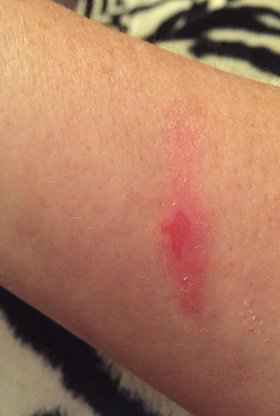 2nd degree burn forearm Day 7